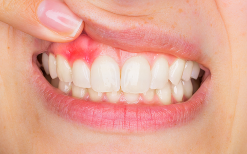 Diş Taşı Temizliği - Dişeti Hastalıkları (Periodontoloji)